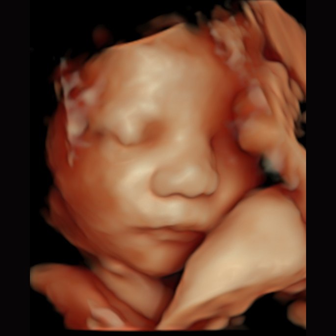 HD Live 3D ultrasound of a baby's face — Wonder Time